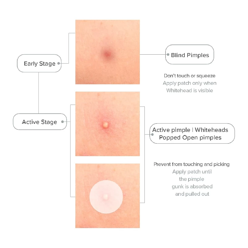 Priveda Acne Pimple Patch, 20 g-2.webp